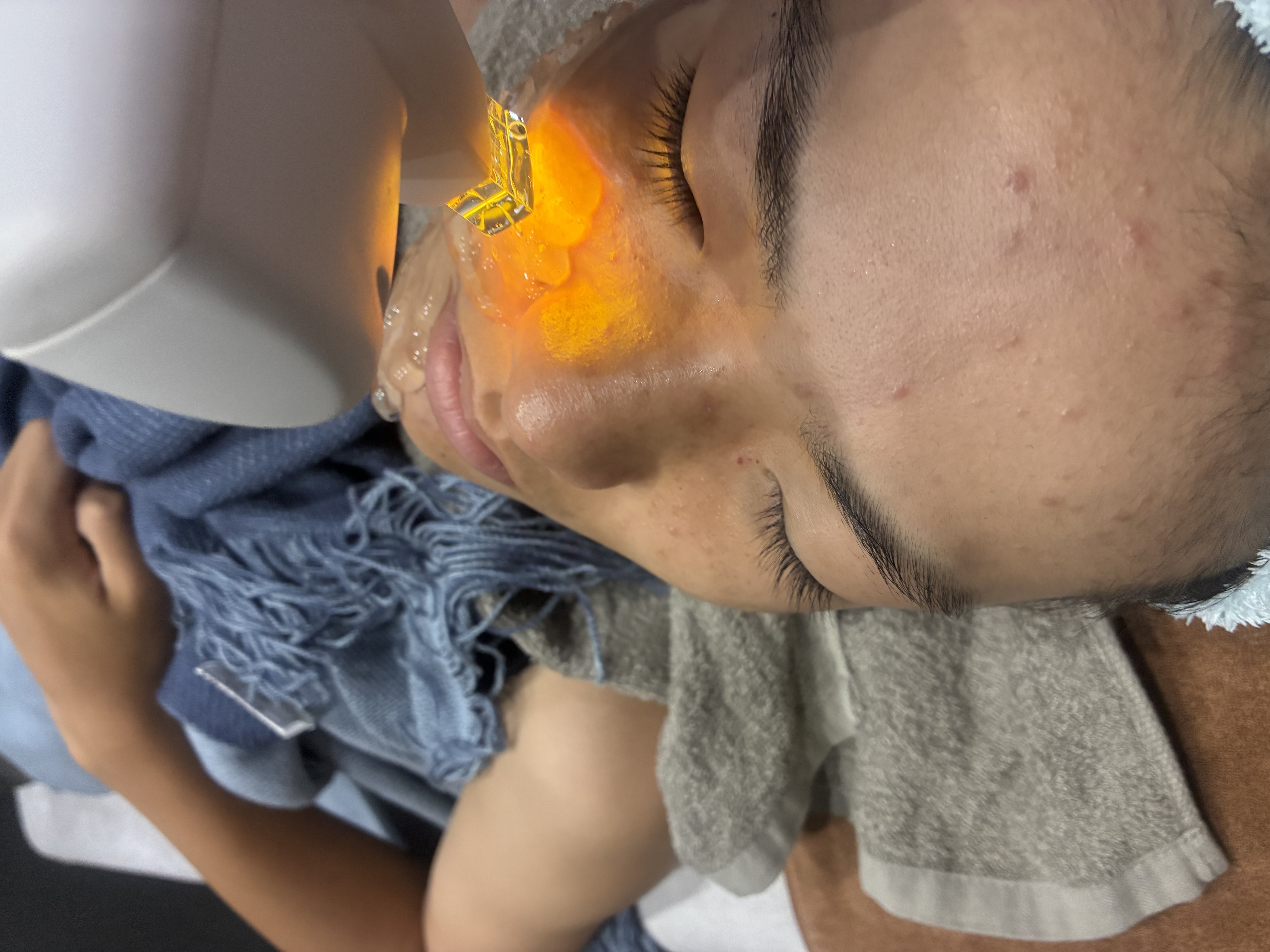 シミ取り効果