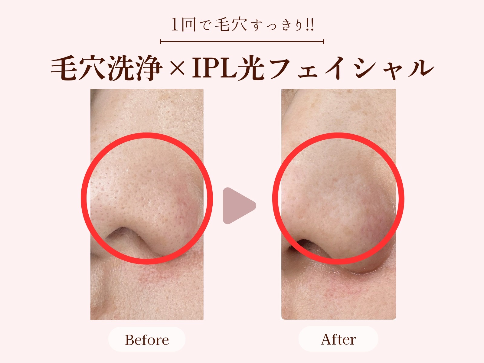 5. フォトフェイシャルの魅力